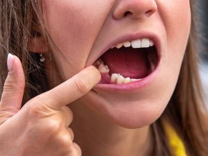 Restore missing teeth with immediate dental implants in London